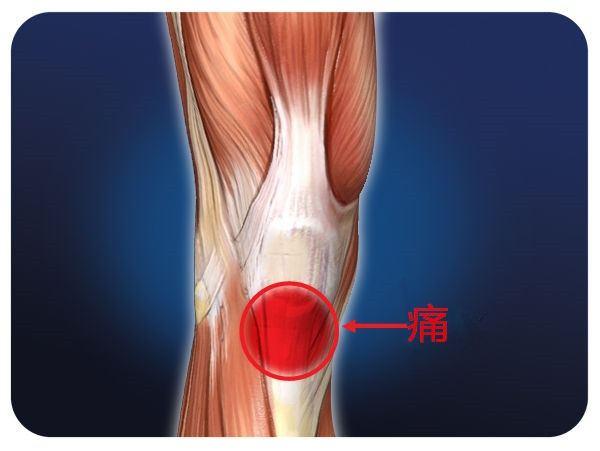 髌韧带损伤症状图片