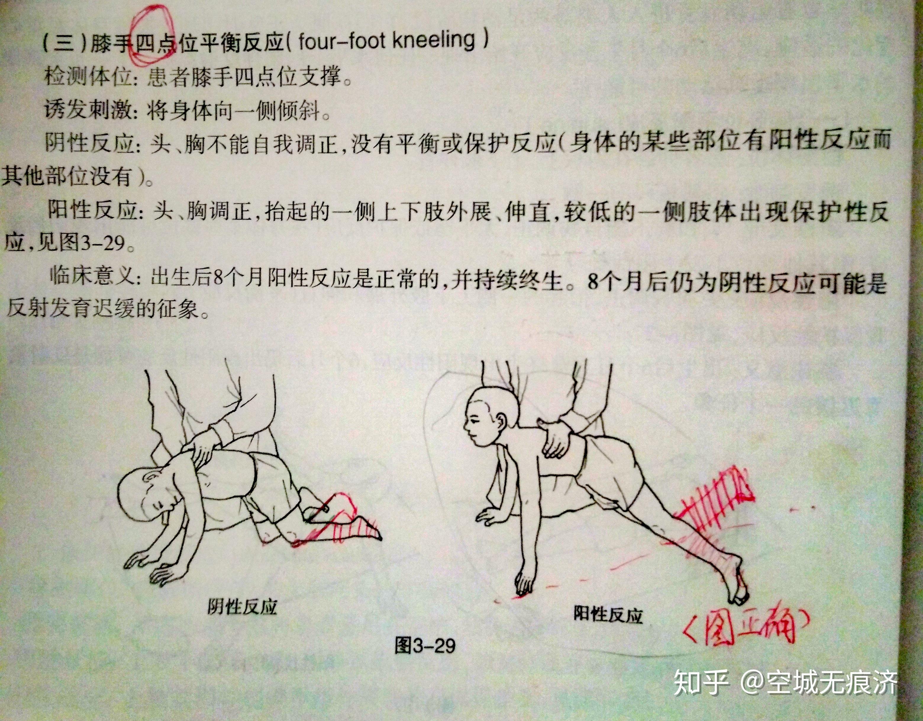 平衡反应①仰卧位平衡反应【脑瘫患者做不了】【正着】检测体位:患者