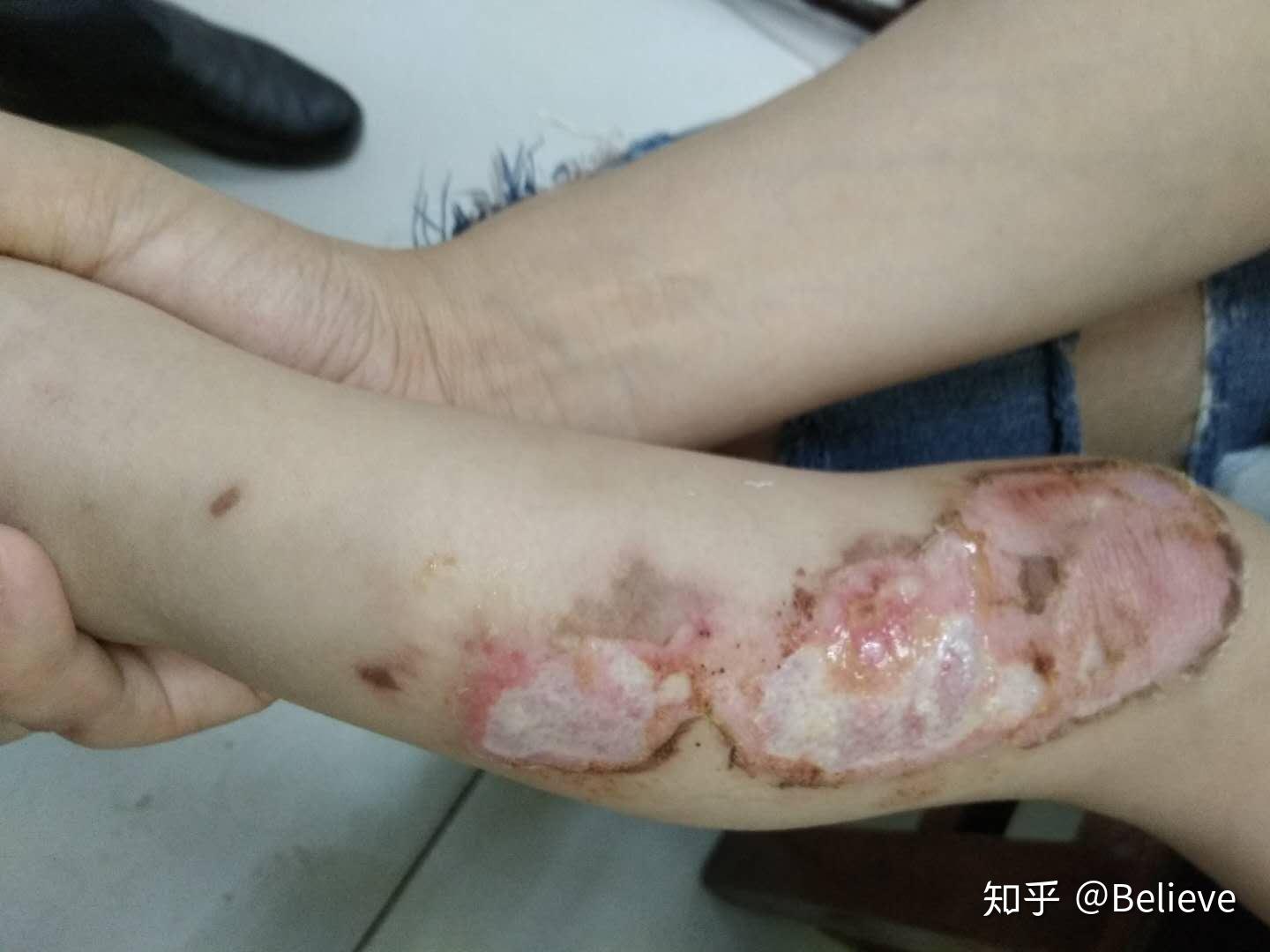 孩子深二度烫伤处理流程跟进中