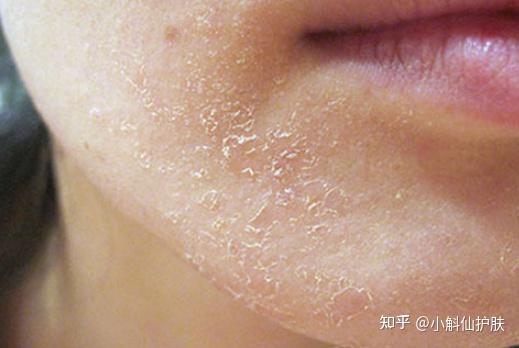 细说『油痘皮』，你跟水光肌还差多远？ - 知乎