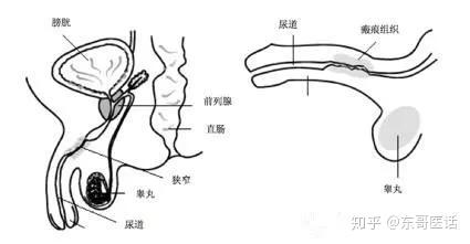 引发尿道狭窄的原因有很多,一般有尿道外伤,尿道手术病史,尿路感染