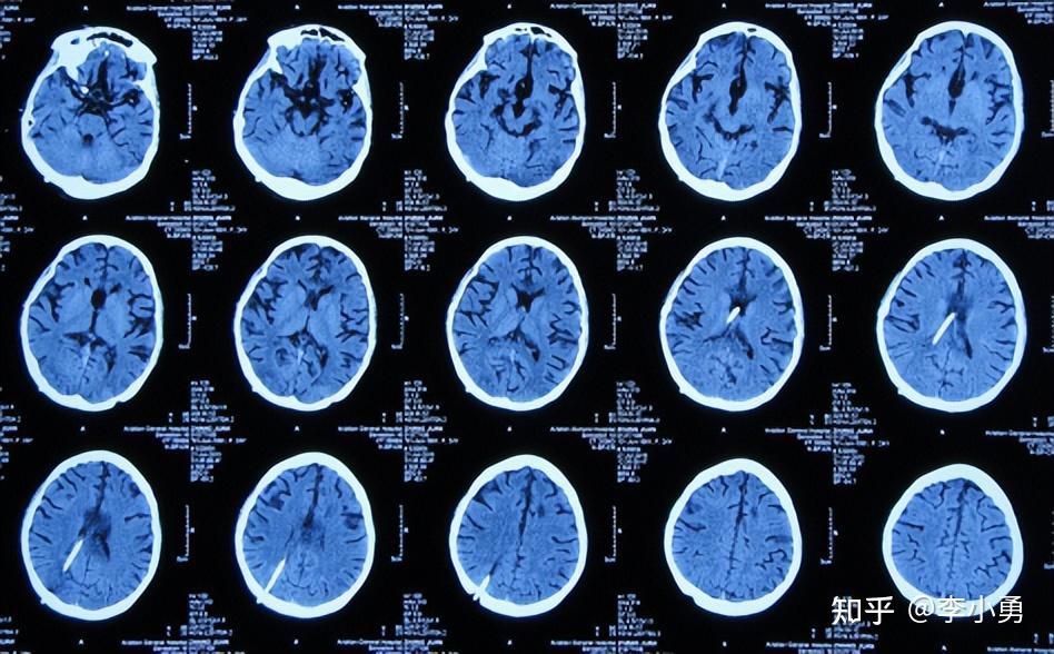 檢查ct後發現有腦積水(圖-1),再查頭顱核磁(圖-2)後認為是