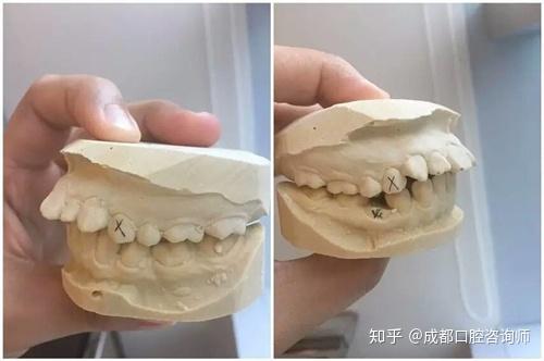 齿性龅牙多为后天在恒牙生长期内形成,少部分是由于遗传,而骨性龅牙