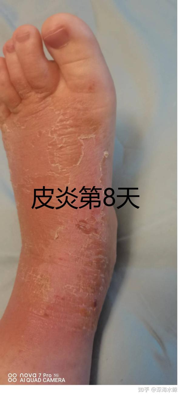 从脚踝扭伤到接触性皮炎的血泪经历 - 知乎