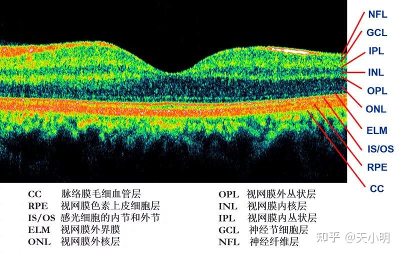 oct能观察到黄斑区视网膜各层次结构的细微变化