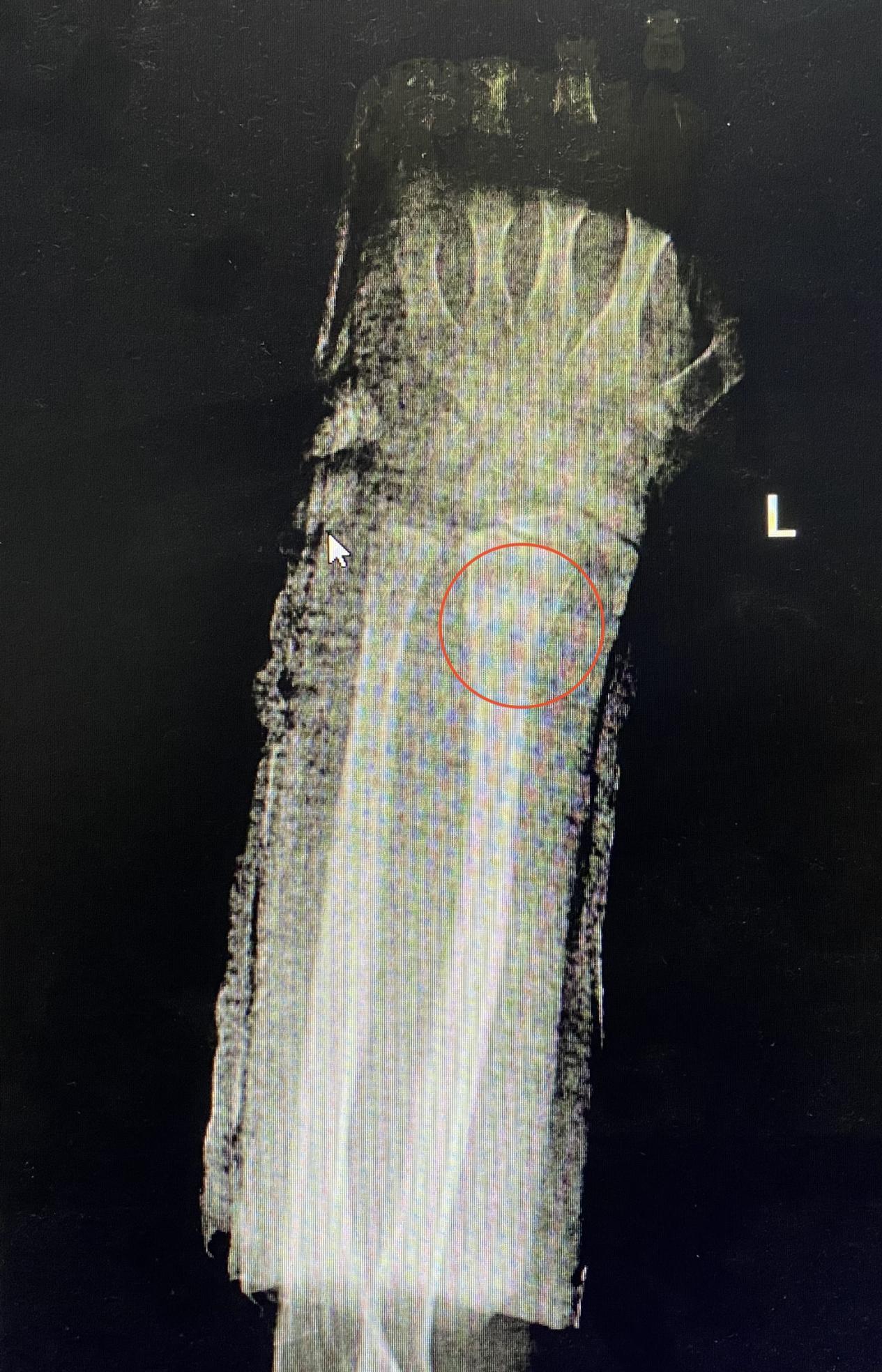 朱医生的患者故事8岁男孩手腕骨折需要不需要做手术