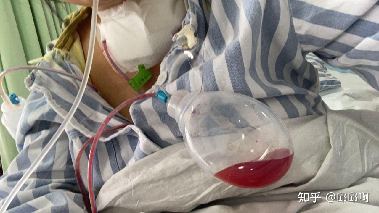 甲状腺癌全切术 淋巴结清扫术后恢复篇(三) - 知乎