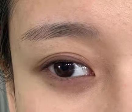 多层双眼皮顾名思义就是在上睑位置重睑线不止一条,有时候会出现很多