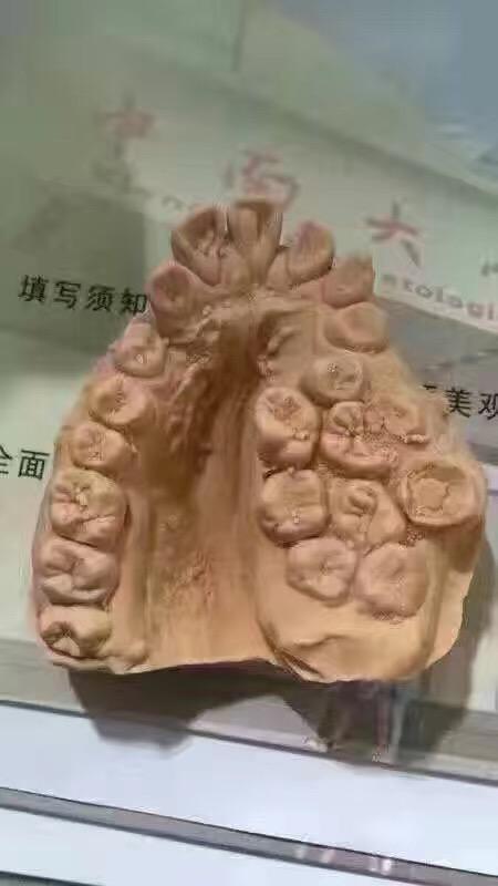 牙医碰见最烂的牙有多烂? - 曹先生的回答 - 知