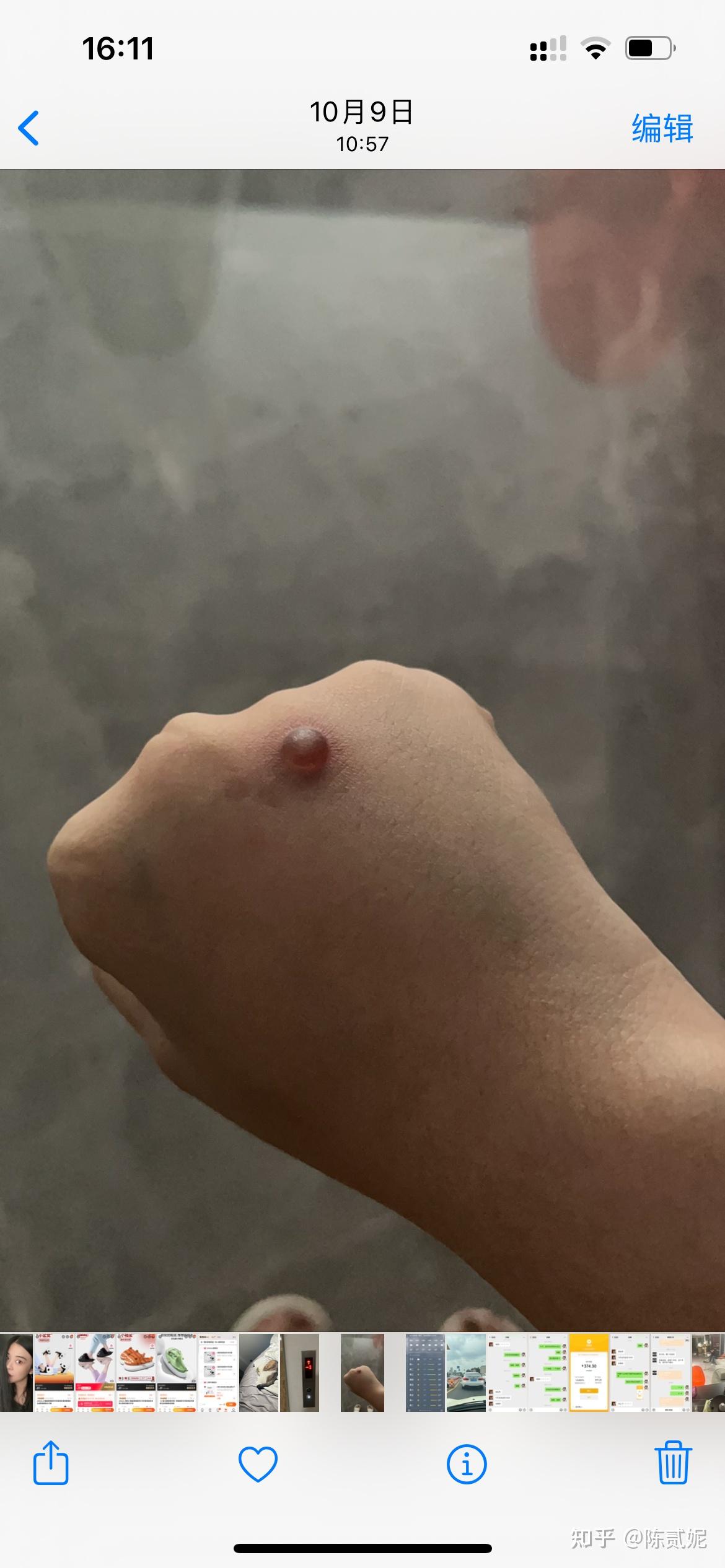 记录一下,用大蒜治疗寻常疣,持续更新