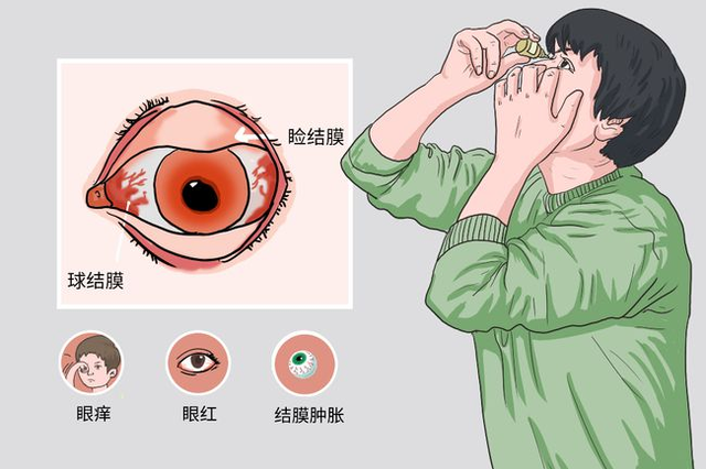 双目红肿痒，得了过敏性结膜炎怎么治疗？ - 知乎