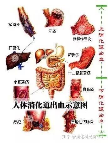 秋末冬初之际消化道出血患者为何增多