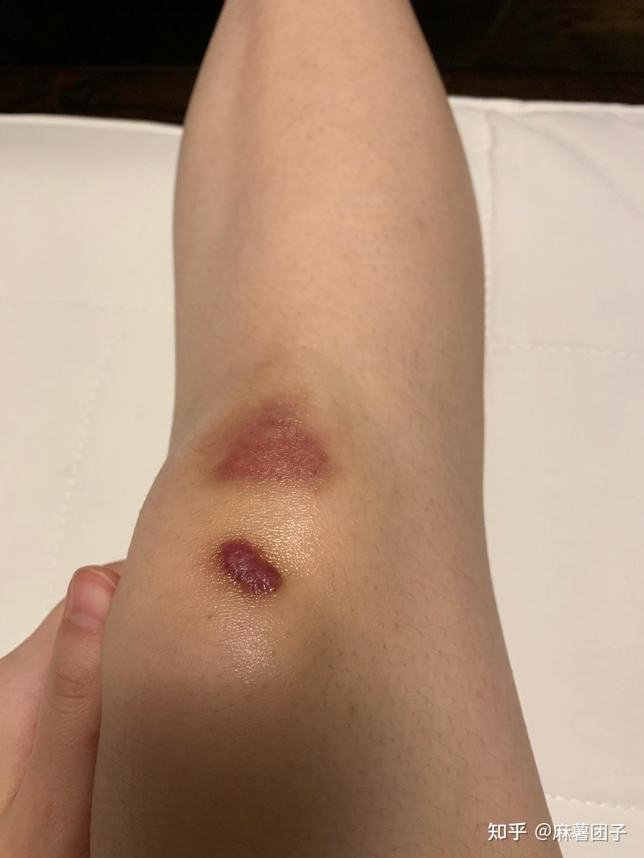 每次穿上心爱的小裙子,都能看到腿上明显的疤痕,心情一下子就低入谷底