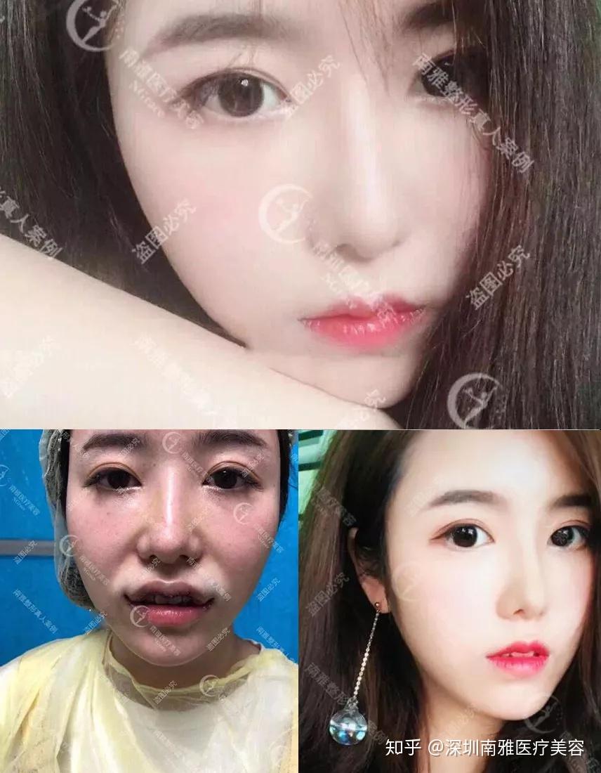 微笑唇m唇嘴角上扬术对唇形的改善