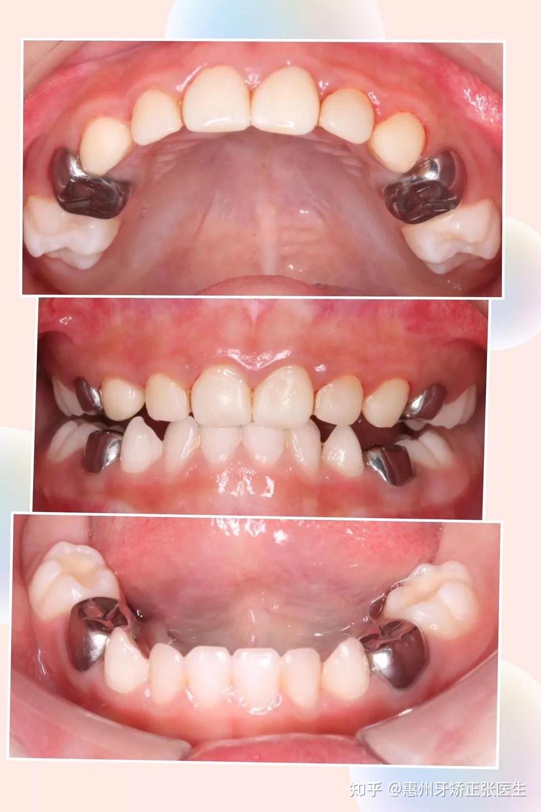 乳牙斷裂的牙科處理 | 小太陽牙醫診所