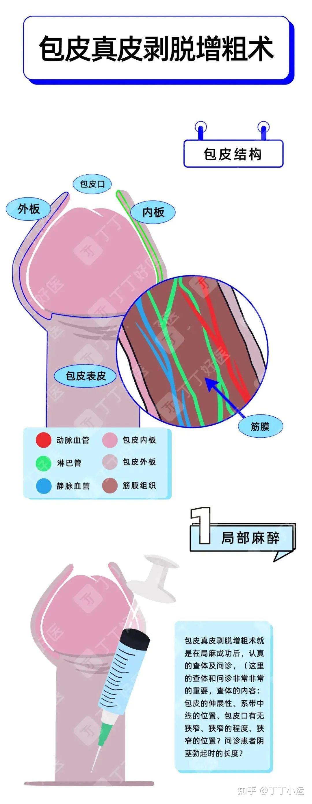 包皮过长应该切多长?术前提前划线的重要性 - 知乎