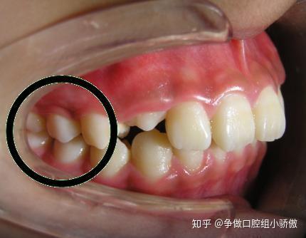 正畸安氏分析法Ⅱ类丨与牙医高效沟通的秘籍 - 知乎
