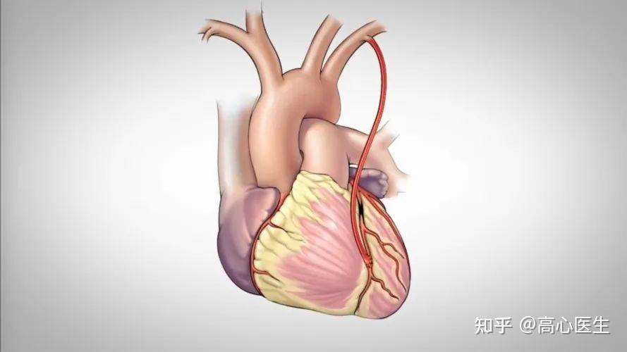 冠状动脉搭桥:用患者自身的大隐静脉或其他部位血管作为"桥血管"