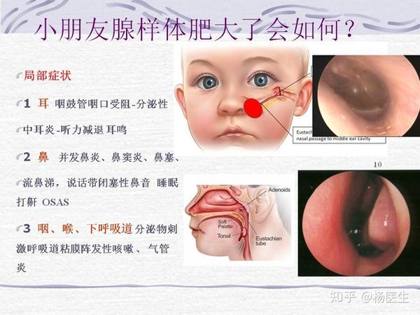 腺样体肥大- 知乎