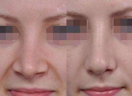 3,对于鼻翼过厚或者鼻翼沟上部太丰满的患者来说,可以通过沿着鼻翼