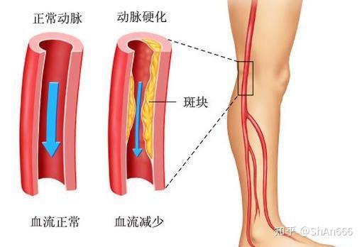 喝什么茶通血管效果好 v2-2fc96fd60fa299e6bc4ca586712f90de_r.jpg