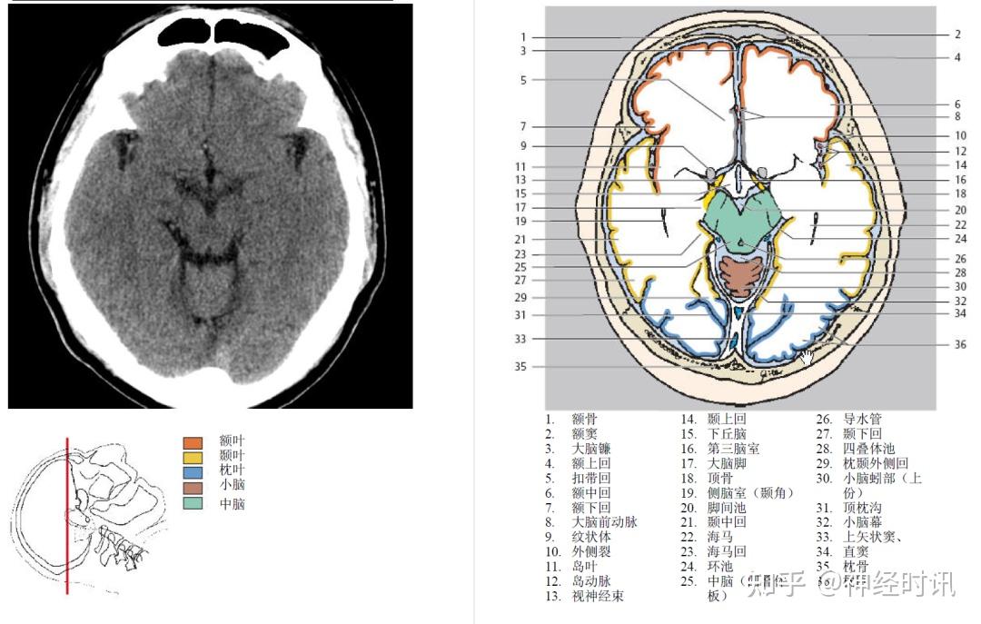 大腦外側窩池在橫斷面上的典型表現呈橫置的 