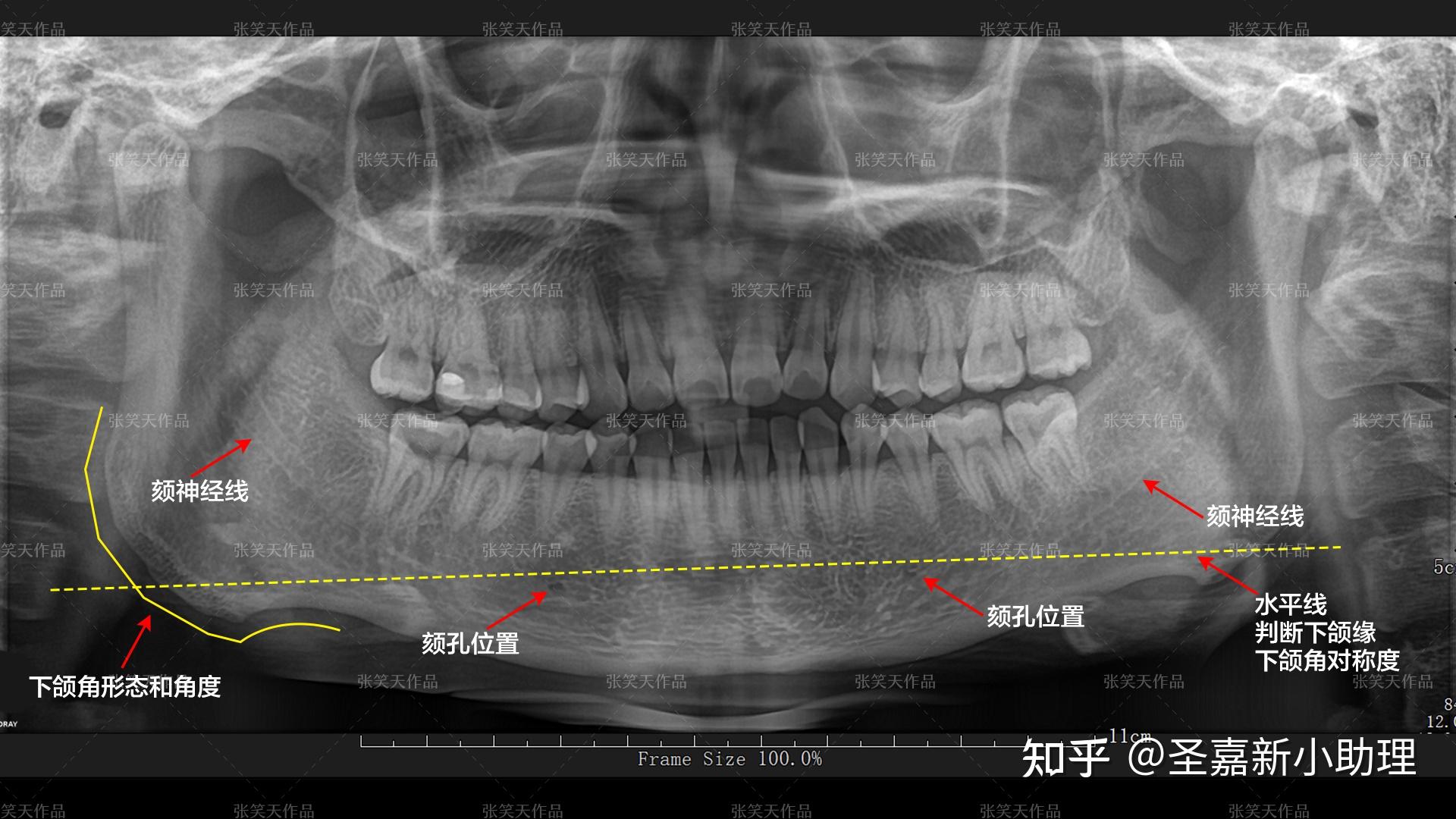 口腔的全景片可以看到下颌角的形态和角度,可以看到颏孔的位置和神经