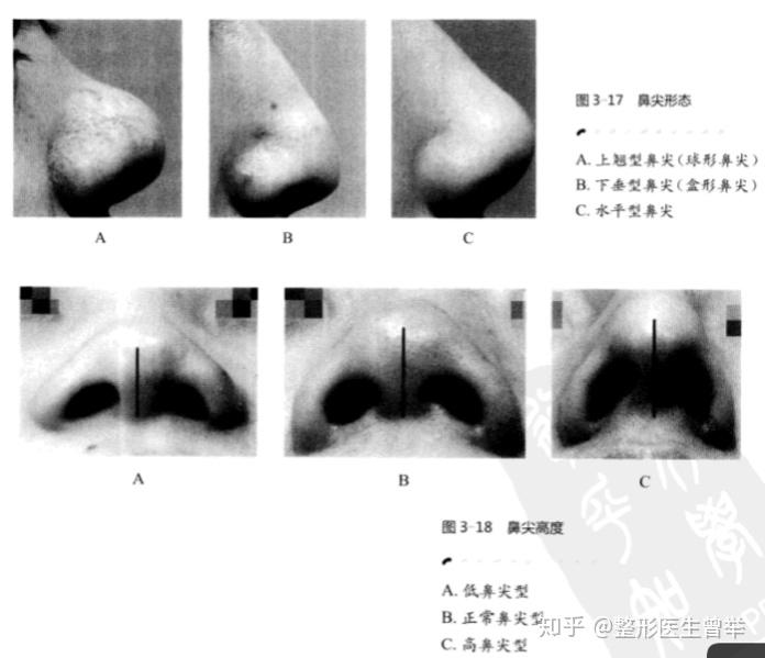 鼻整形科普:认识鼻背、鼻尖、鼻翼、鼻小柱、鼻孔分类,看看你属于哪个类型 - 知乎