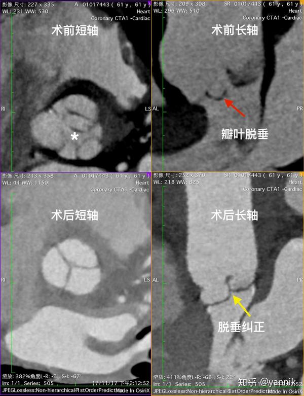 是时候展现真正的技术了:成人主动脉瓣疾病的福音 —— 瓣膜修复 - 知乎