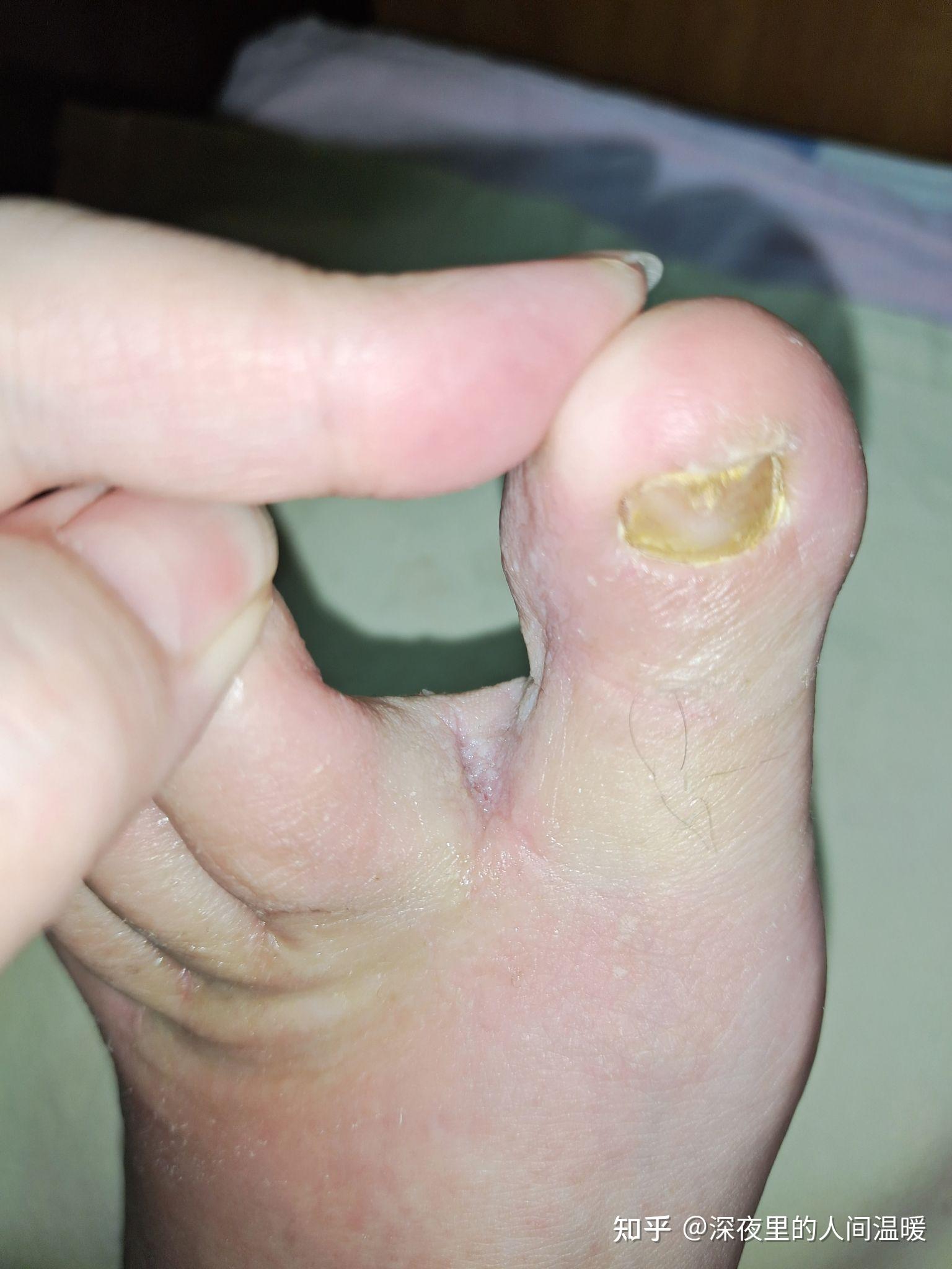 灰指甲2021年1月