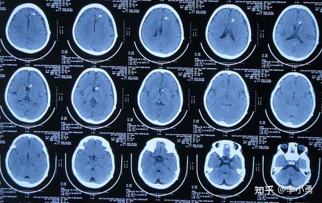 脑膜炎性脑积水4家医院8次住院3次手术三室造瘘脑室