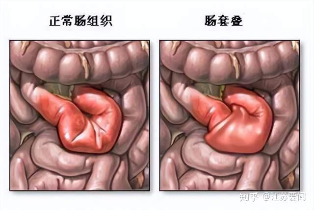 人生無常大腸包小腸最常見的嬰幼兒急腹症急性腸套疊