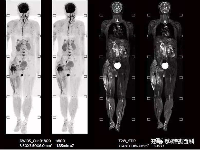 磁共振全身成像技术一