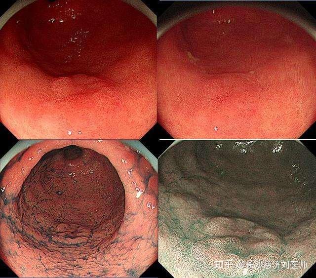 咽喉干痒有异物感如何快速检查是咽炎还是食管癌作怪