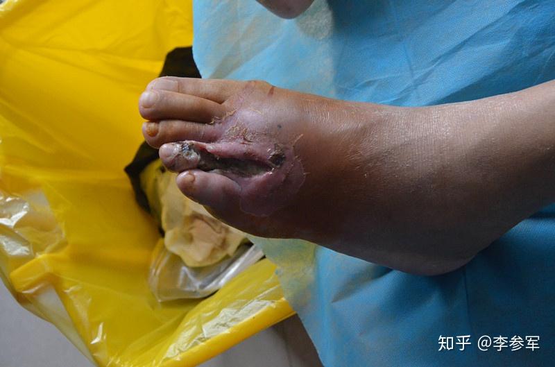 糖尿病足创面治疗愈合(案例)