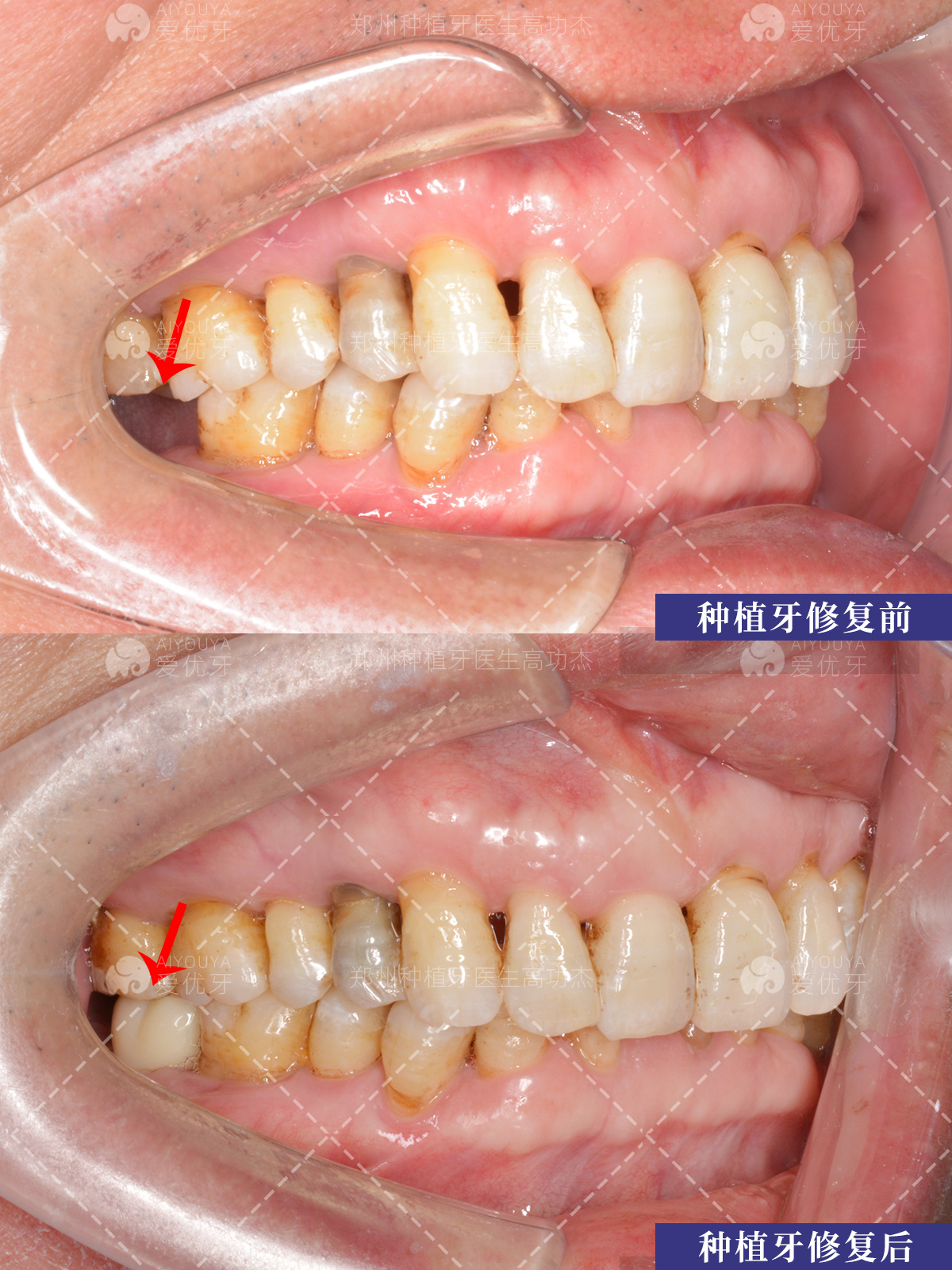 郑州种植牙|右侧下颌7号牙缺失,iti种植,三期戴牙! - 知乎