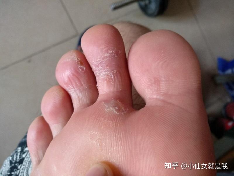 得了脚气用什么药可以多久能好