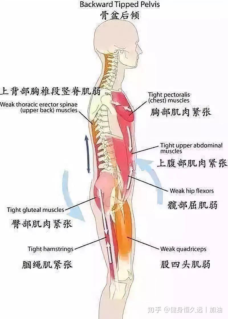 表现:腰椎前突减少或平背;骨盆后倾,重心在后,上半身为了维持前后平衡