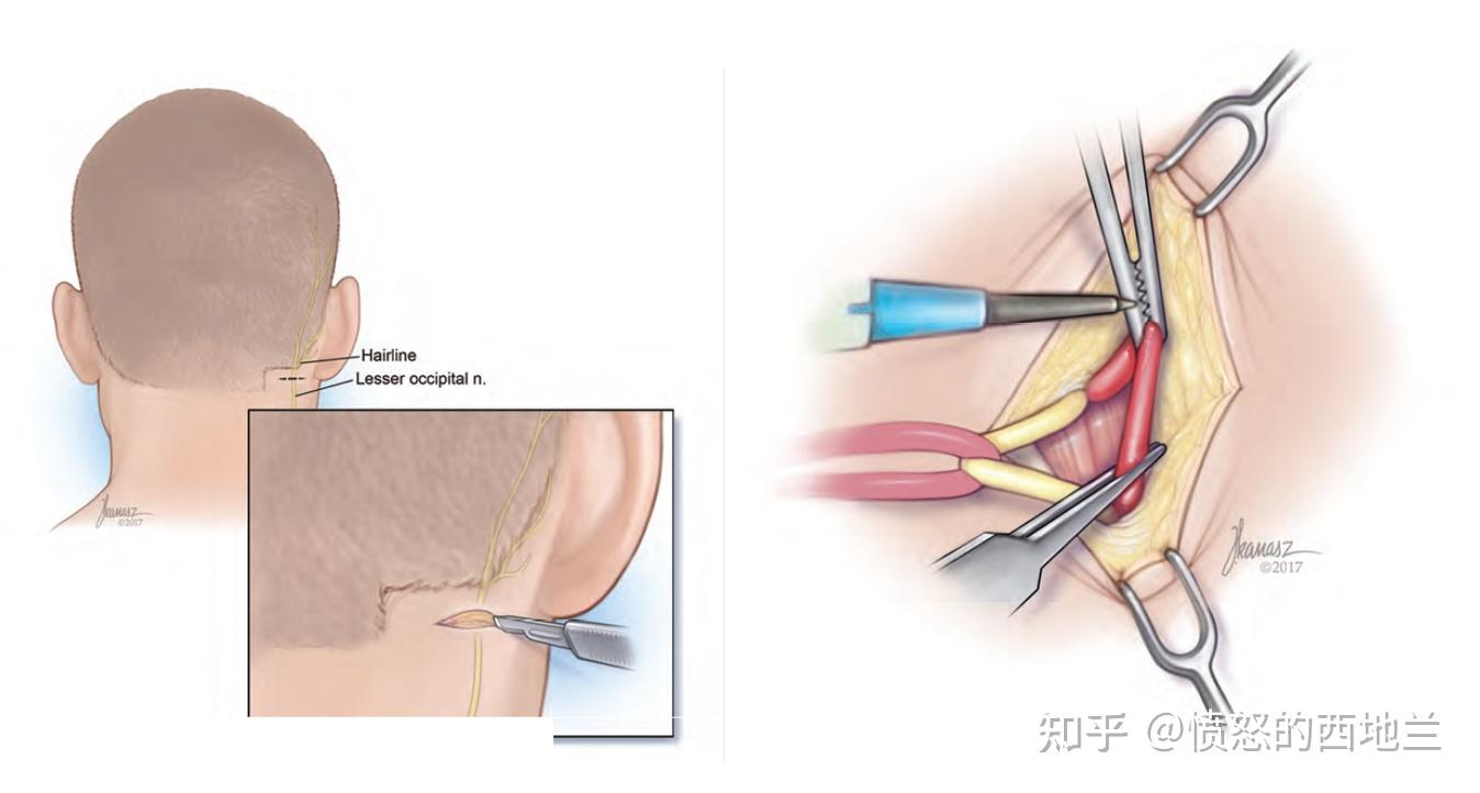 难治性枕神经痛的微创手术治疗--枕小神经痛