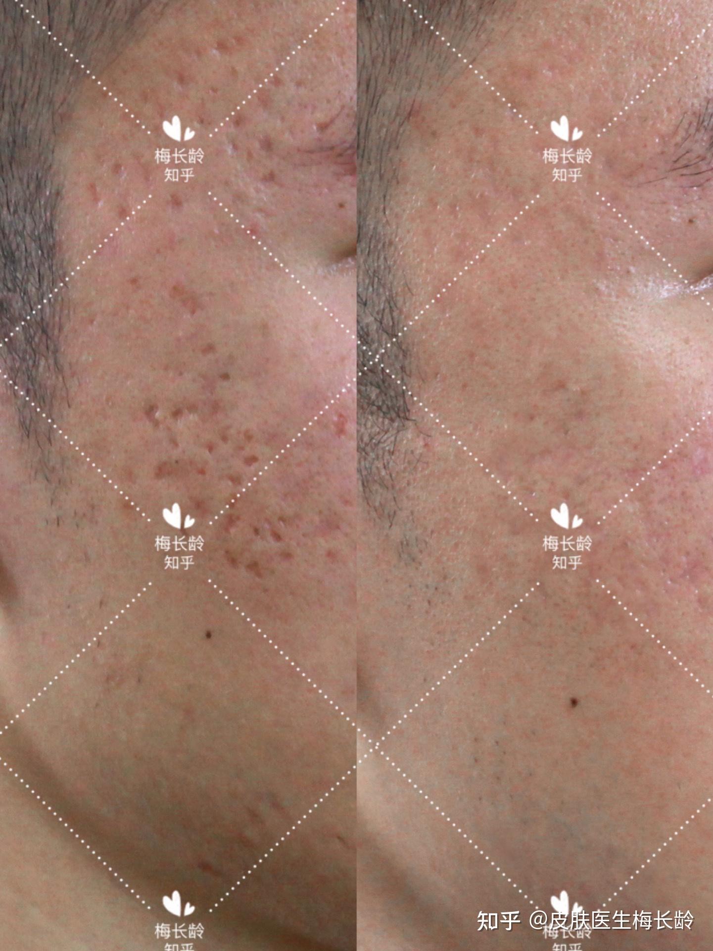 太阳穴厢车型痘坑丨三组综合激光治疗后反馈图来啦