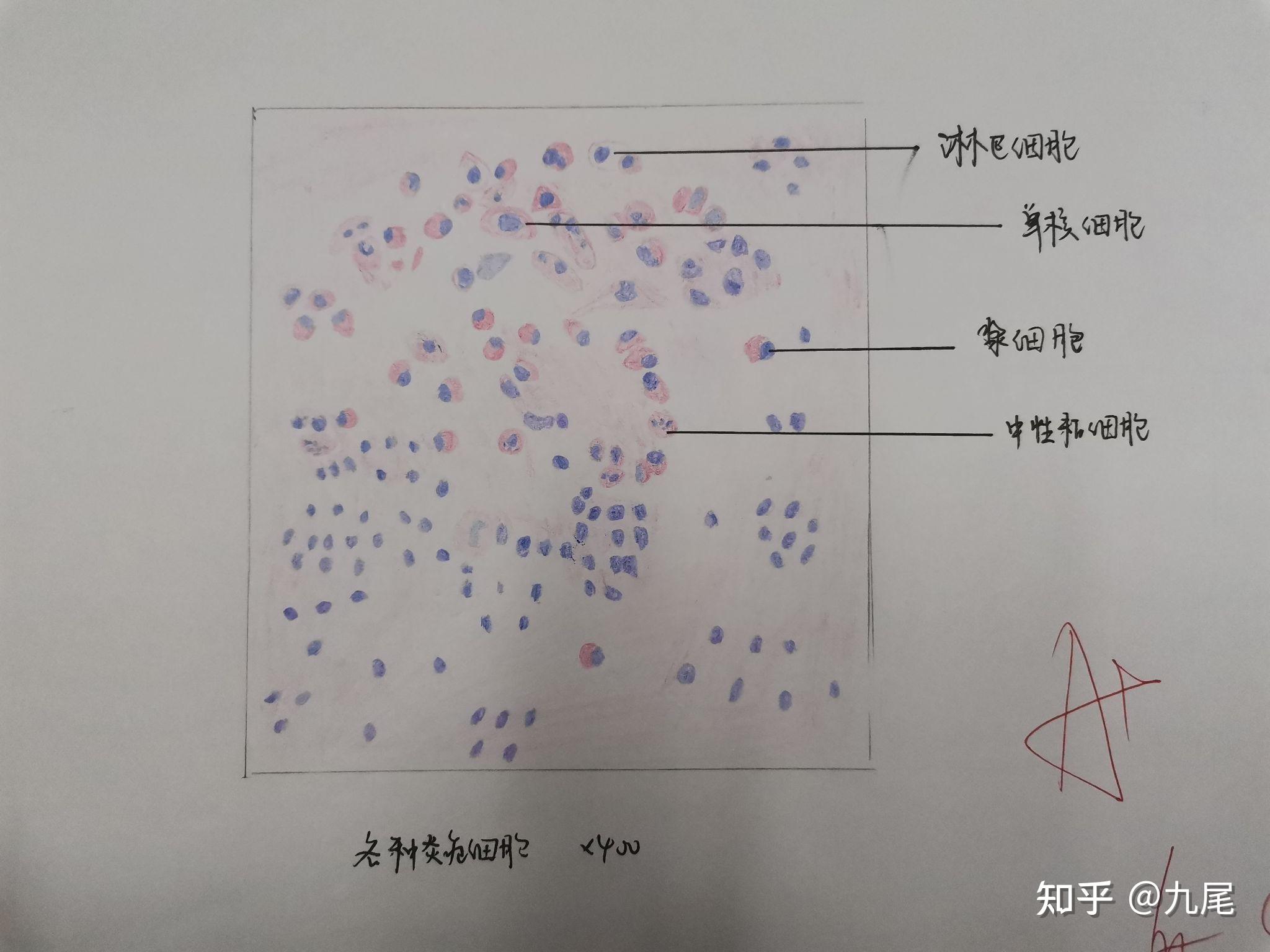 慢性胃溃疡肝硬化慢性肾盂肾炎新月体性肾小球肾炎甲状腺乳头状腺癌