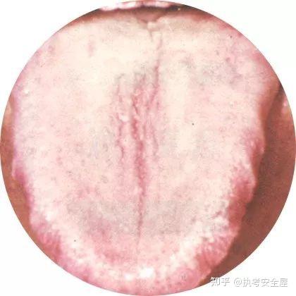 【舌诊大全】120种常见的舌苔超清彩色图谱，建议收藏！ - 知乎
