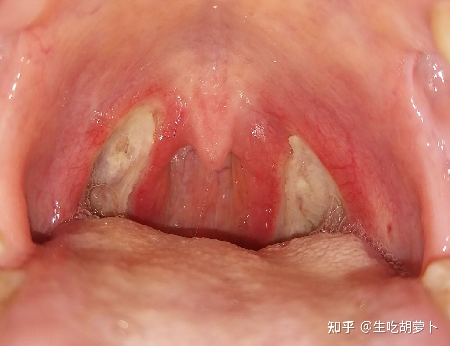 27岁女扁桃体切除手术日常记录