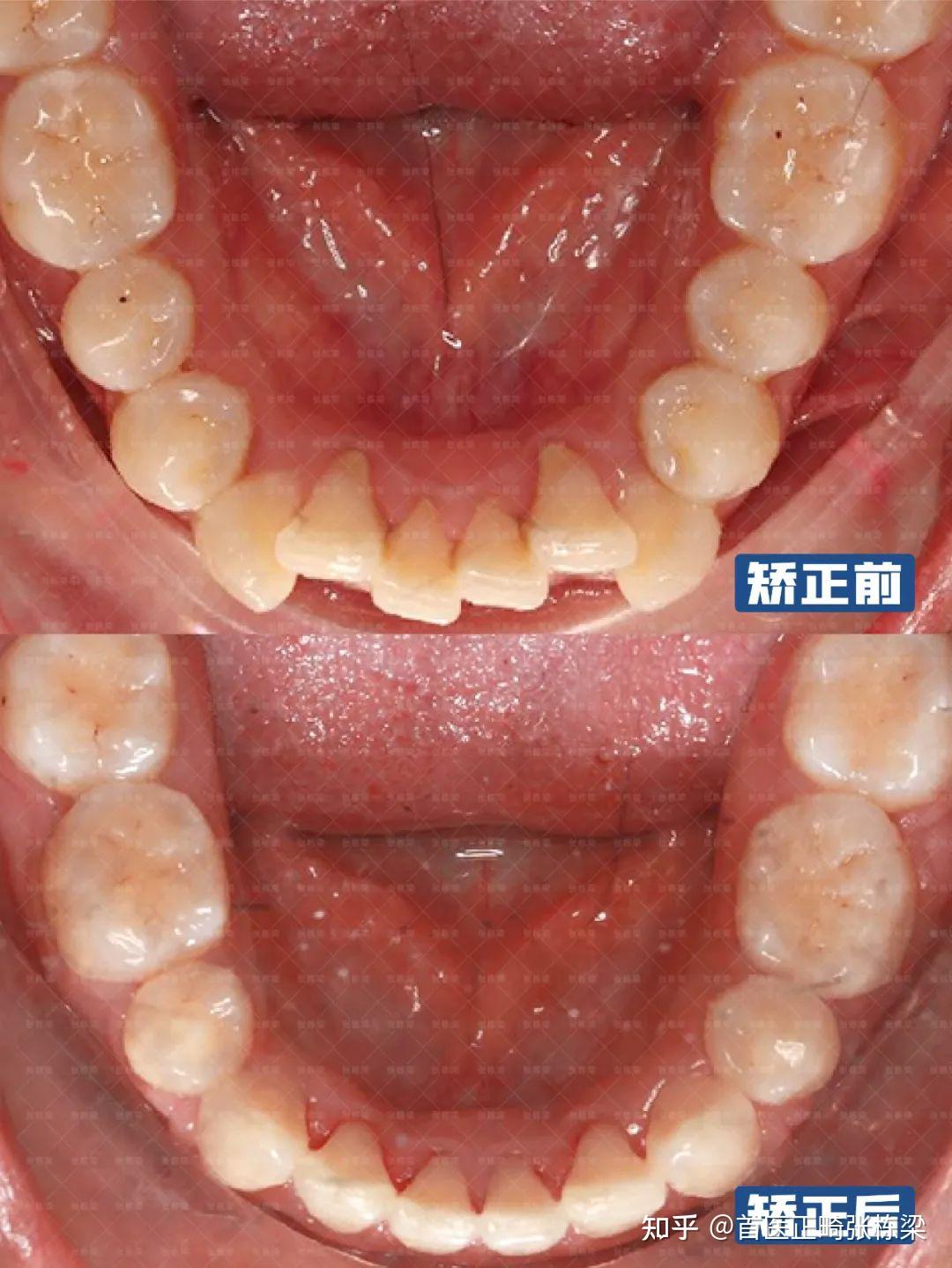 牙骨混合凸嘴矫正，重塑立体五官|济南牙齿矫正 - 知乎