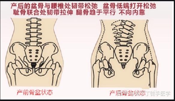 为什么妇科炎症反反复复 你可能要考虑是不是骨盆没有闭合 要做骨盆修复了 知乎