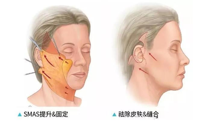 拉皮手术怎么做才好 v2-312694b95aa74f034800640d64fd274e_1440w.jpg?source=172ae18b