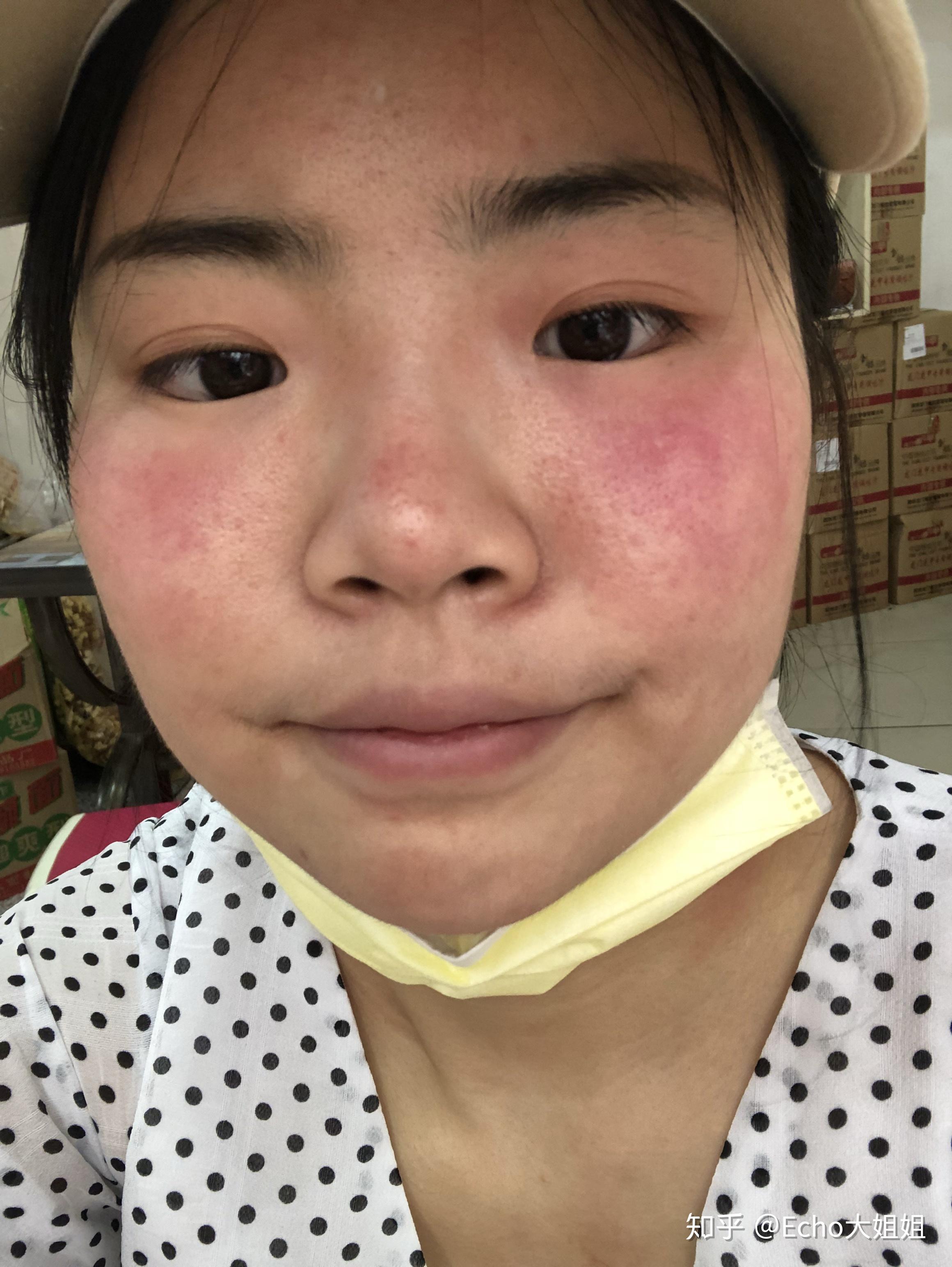 关于脸部皮肤病天知道我经历了什么