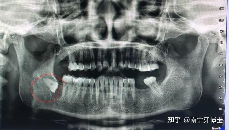 智齒的生長形態存在一定差異,拔牙的話還是要根據個人牙齒情況的,遇到