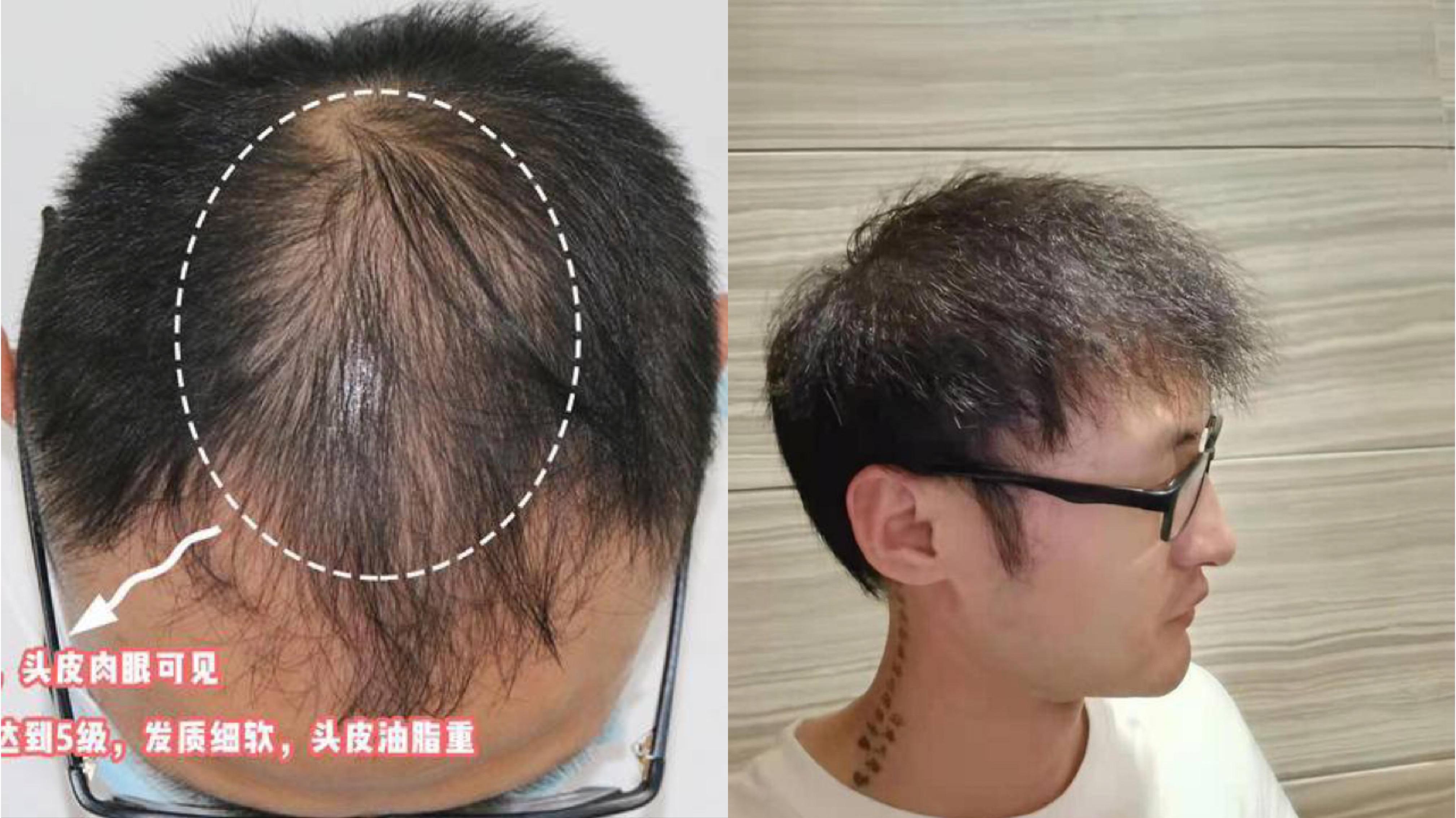 植发五年后脱发严重(植发五年后脱发严重怎么办)
