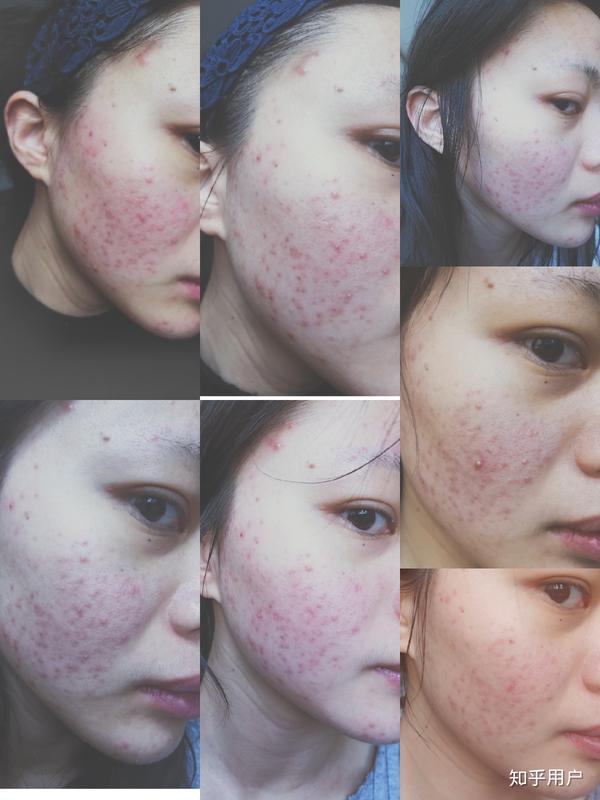 怎么看待五官漂亮但是皮肤差的女性?